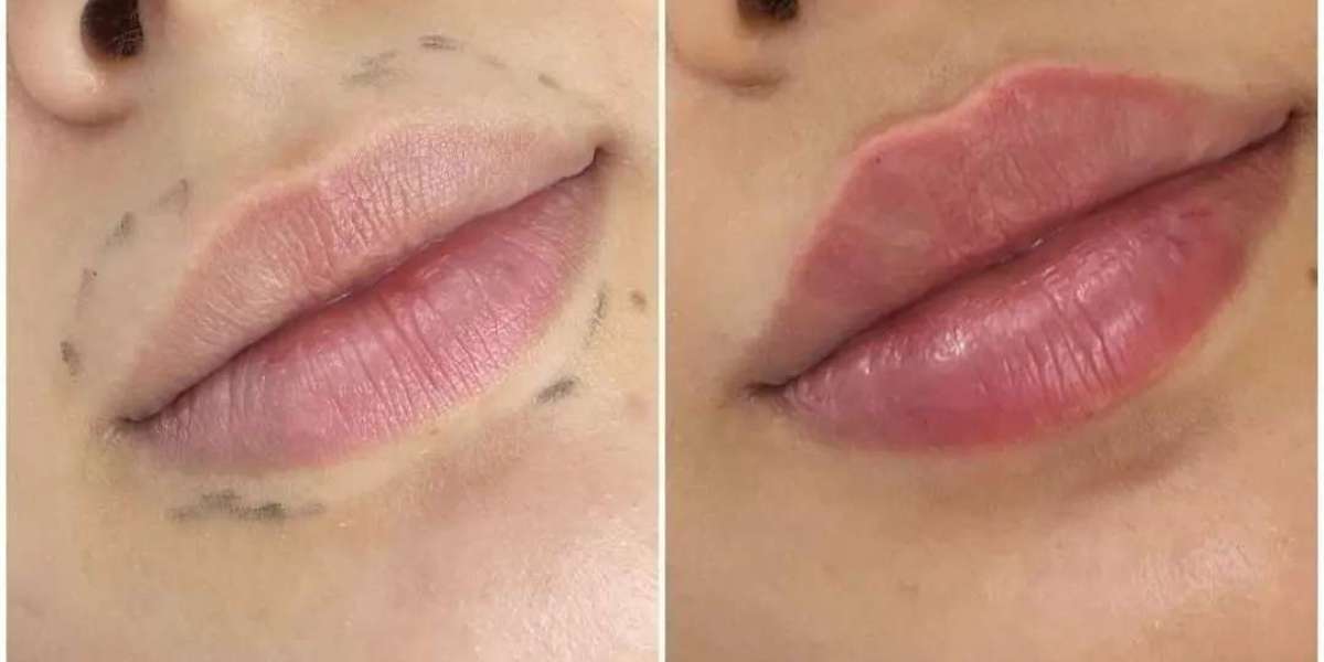 Dermal Fillers for Full Lips: What You Need to Know from the Best Doctors in Dubai