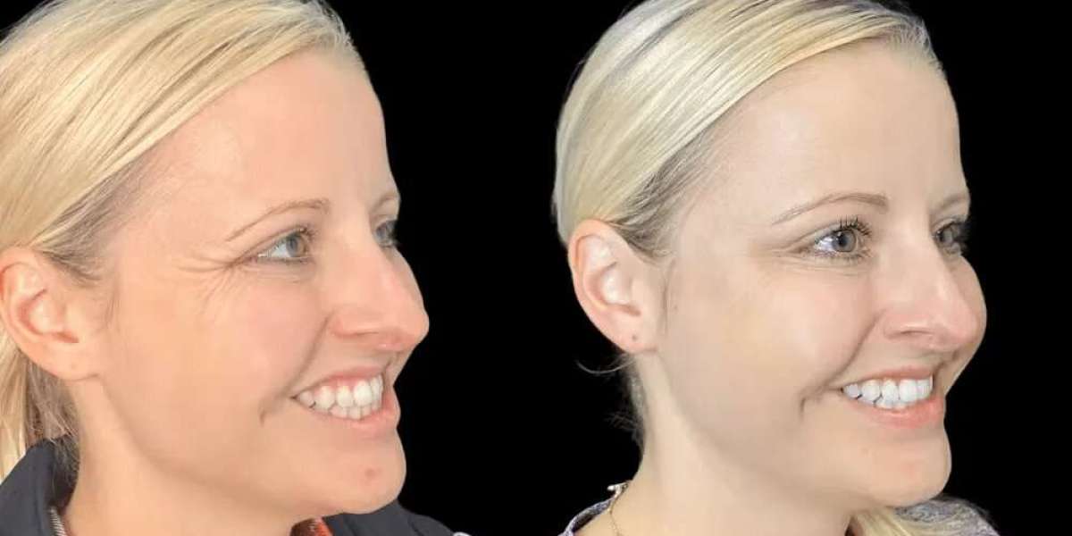 The Rise of Preventative Botox Treatment in Dubai Among Millennials