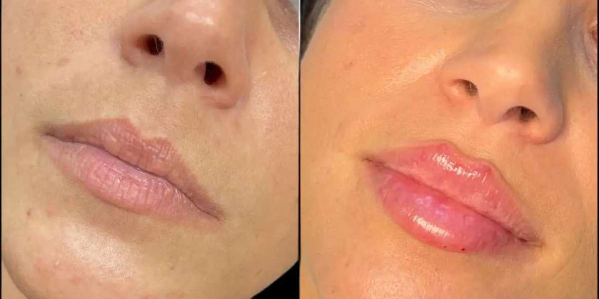 Fillers Before & After by Best Plastic Surgeon in Dubai