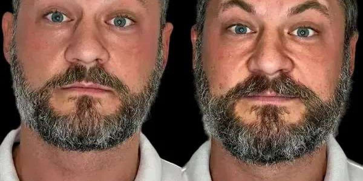 Redesign Radiance Using Profhilo by Best Plastic Surgeons in dubai