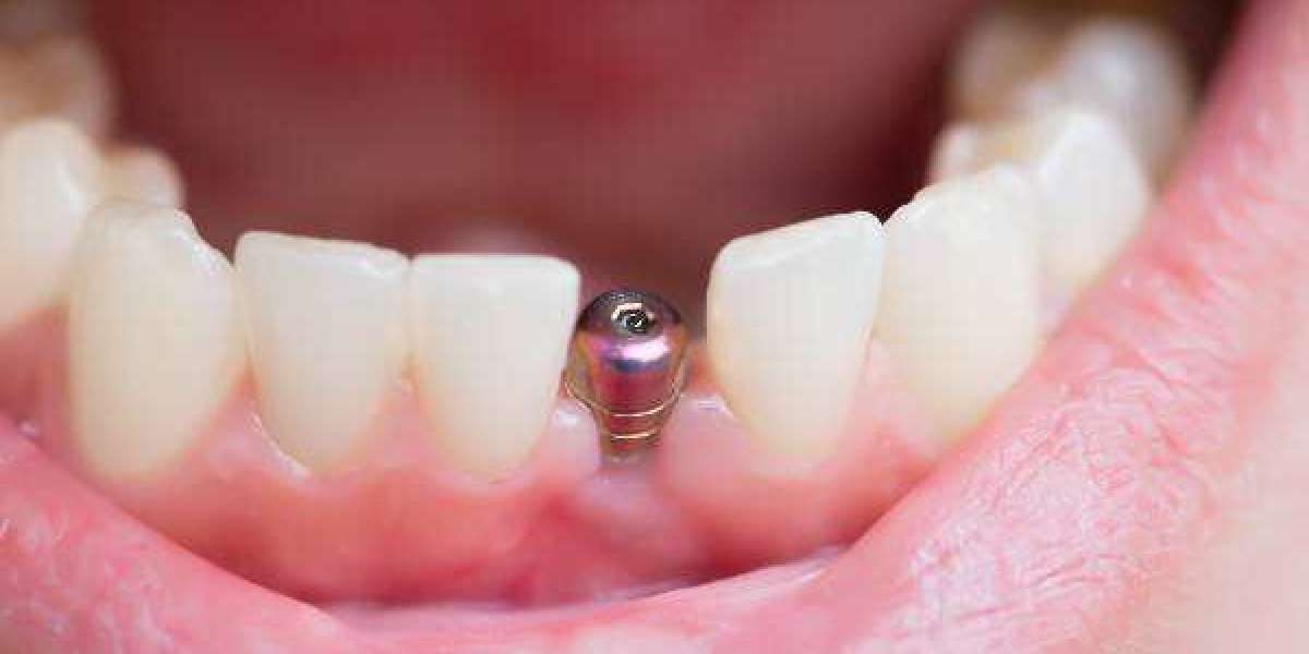 Lost a Tooth Suddenly? Get Fast Relief with Dental Implants