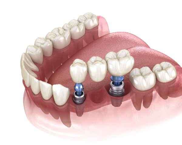 Emergency dentist in Middlesbrough