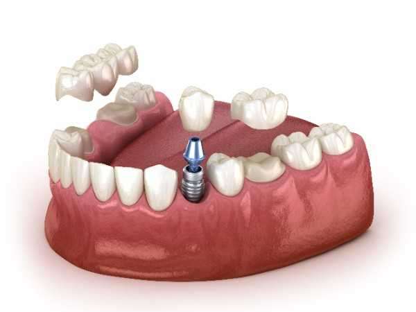 Dental implants Fulham