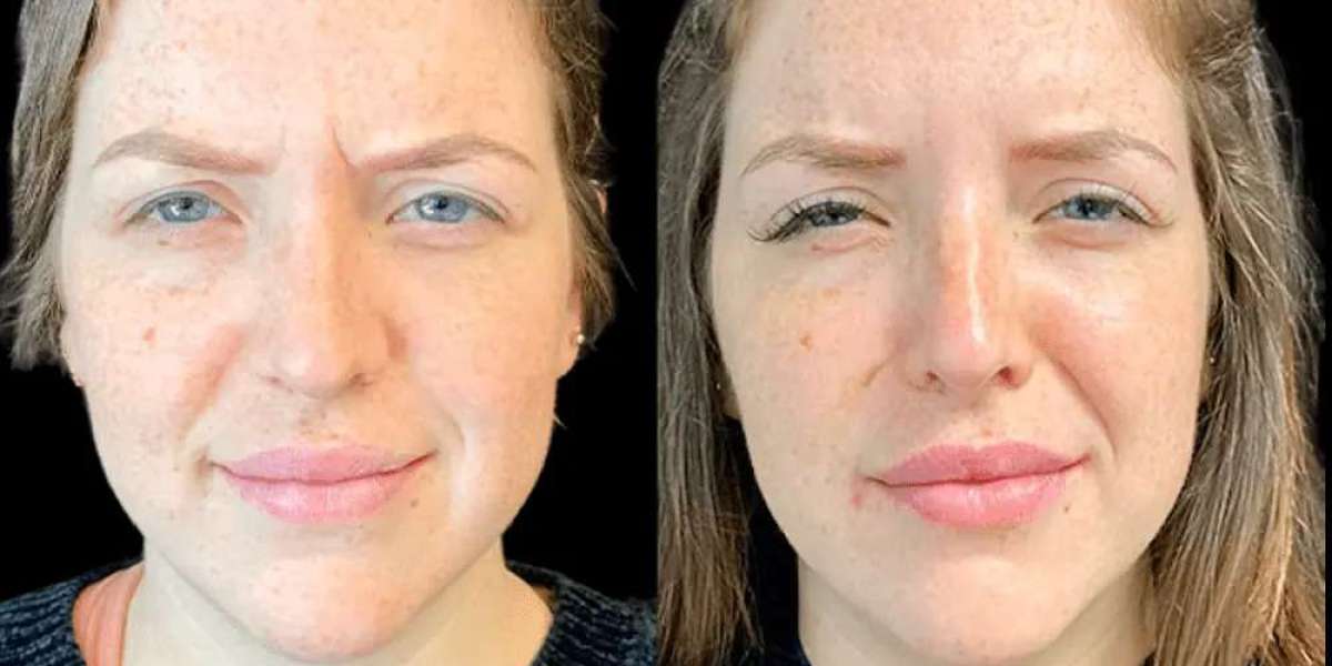 Best Doctors in Dubai for Botox: Expertise, Safety, and Results