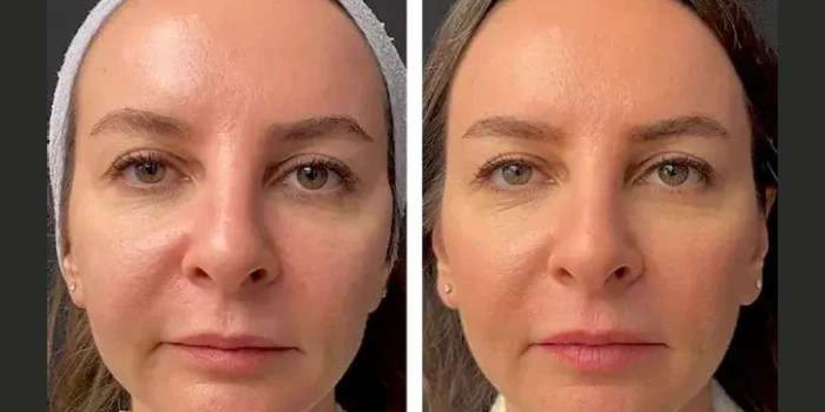 Mesotherapy at Best Aesthetic Clinic in Dubai Delivers Long-Lasting Results