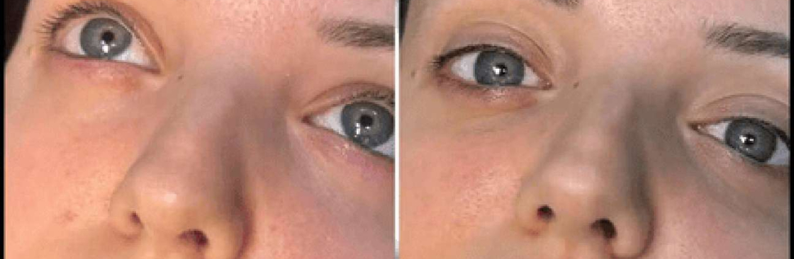 dermal fillers Cover Image