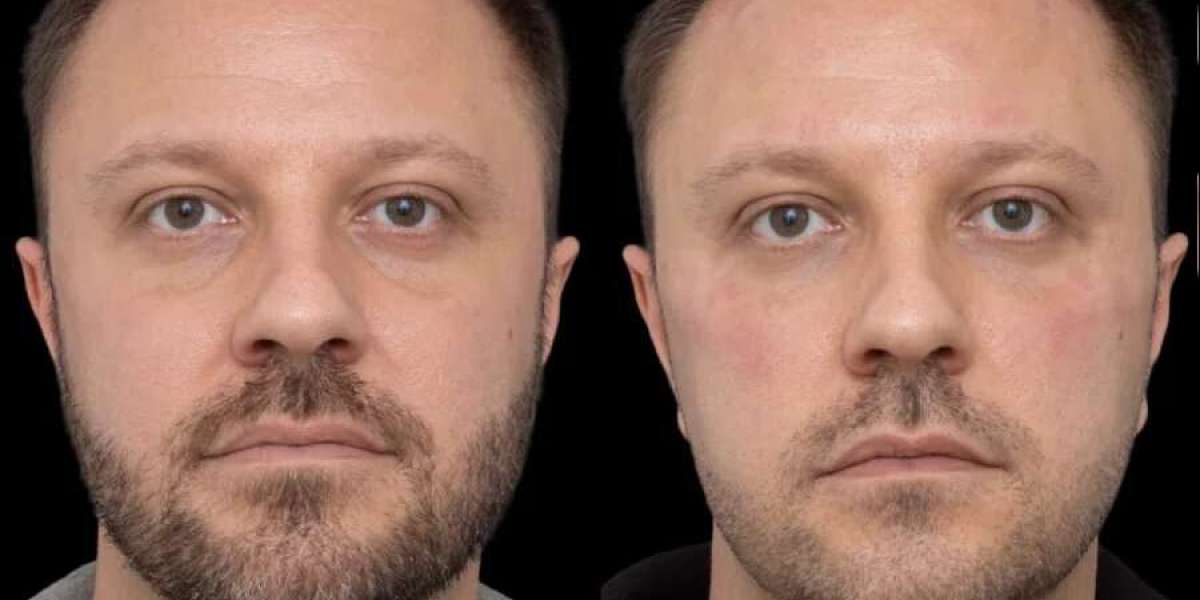 Under Eye Fillers for Aging Eyes by the Best Plastic Surgeon in Dubai