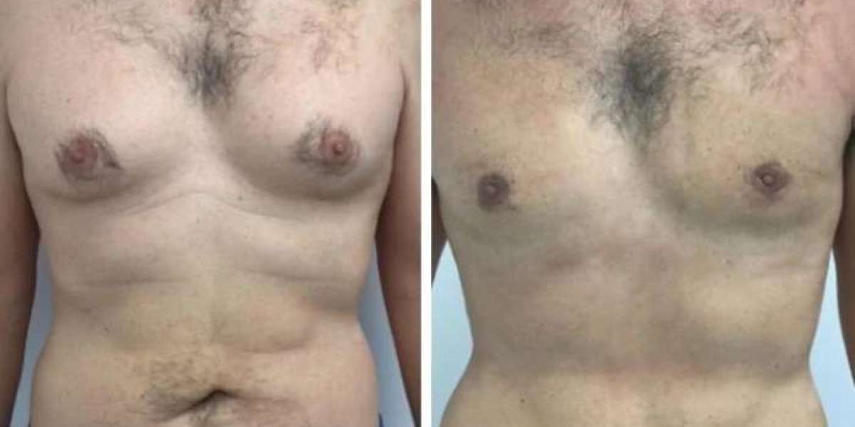Pre-Surgery Preparation Tips from Best Gynecomastia Surgeons in dubai