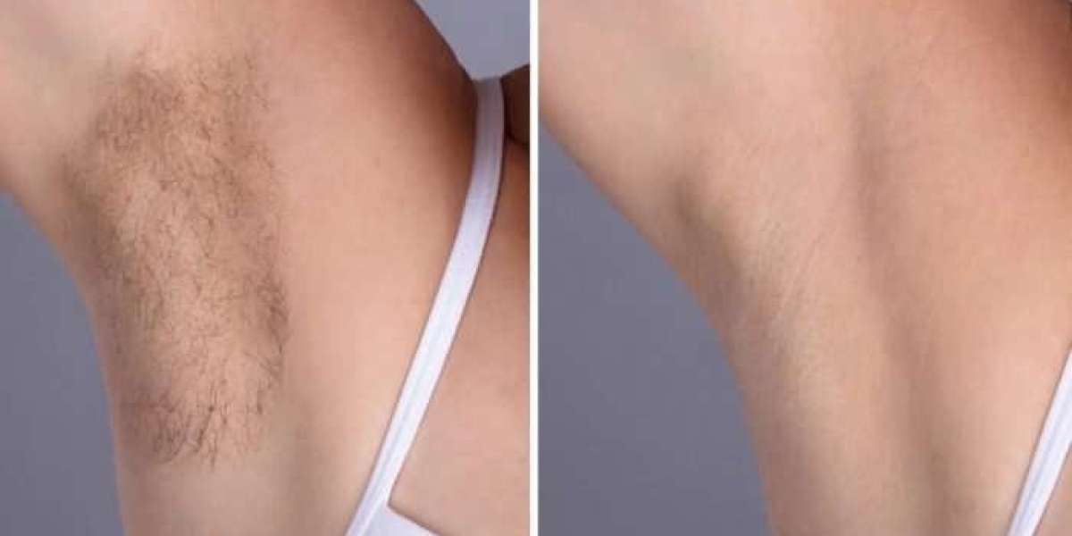 Best Doctors in dubai Laser Hair Removal Specialists