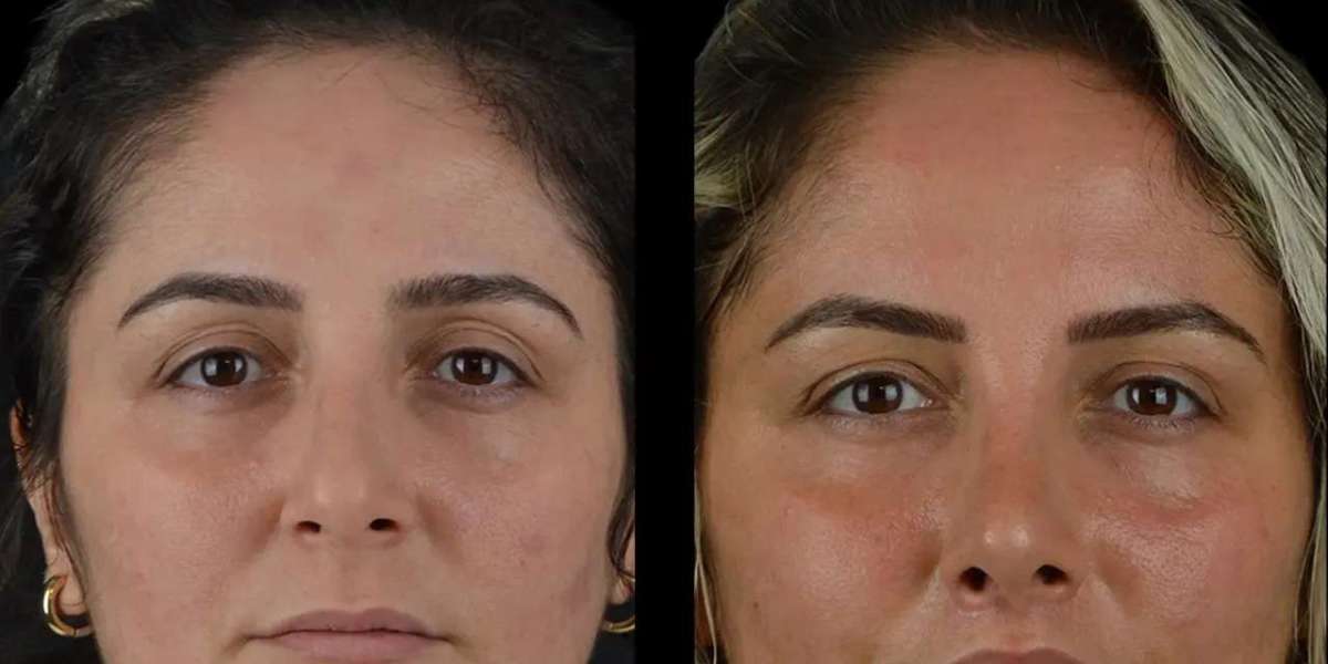 Cheek Fillers for Natural Lift Best Plastic Surgeon in Dubai Insights
