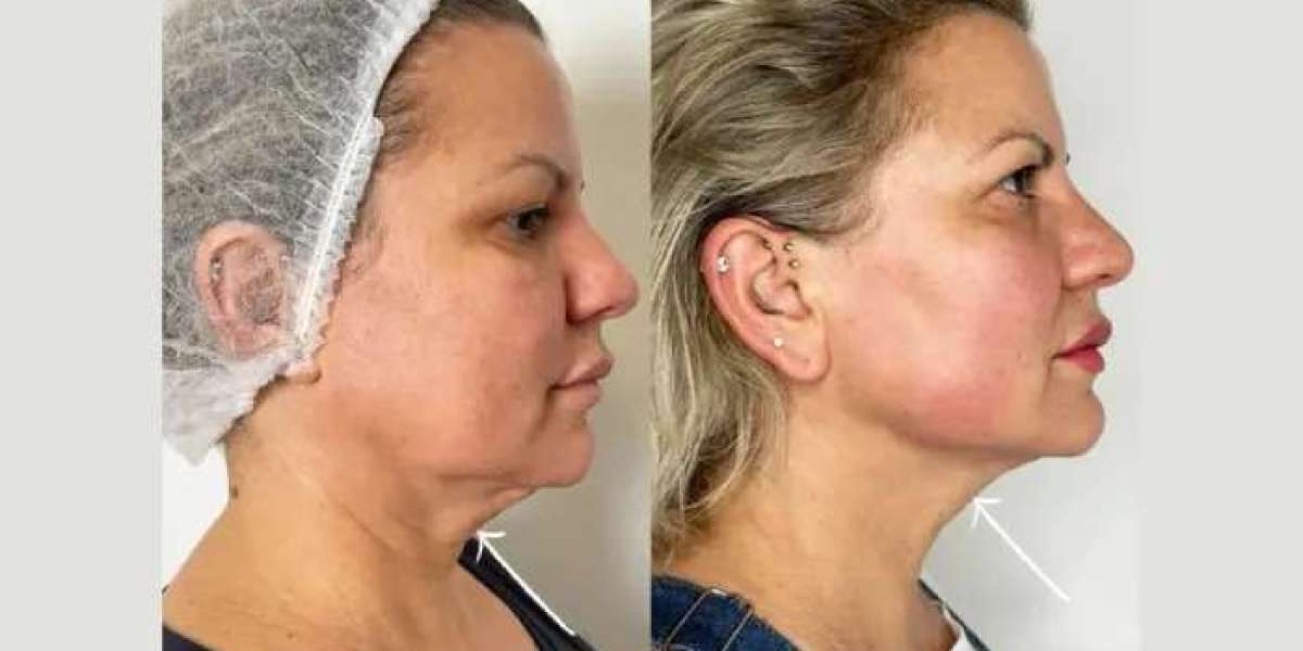 Top 5 Best Doctors in Dubai for Facial Contouring with Endolift