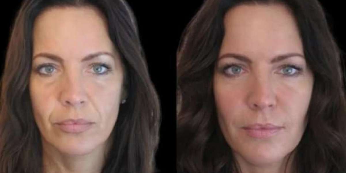 Best Plastic Surgeons in Dubai for Defined and Balanced Jawlines