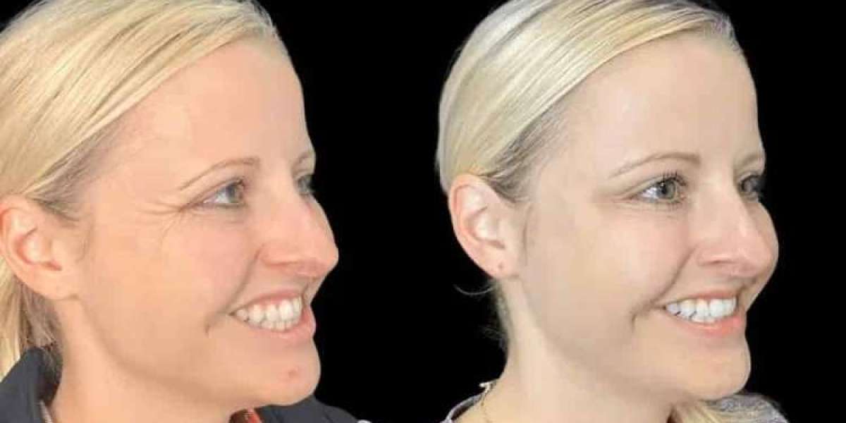 Best Plastic Surgeons in Dubai for Botox Helping Restore Youthful Confidence