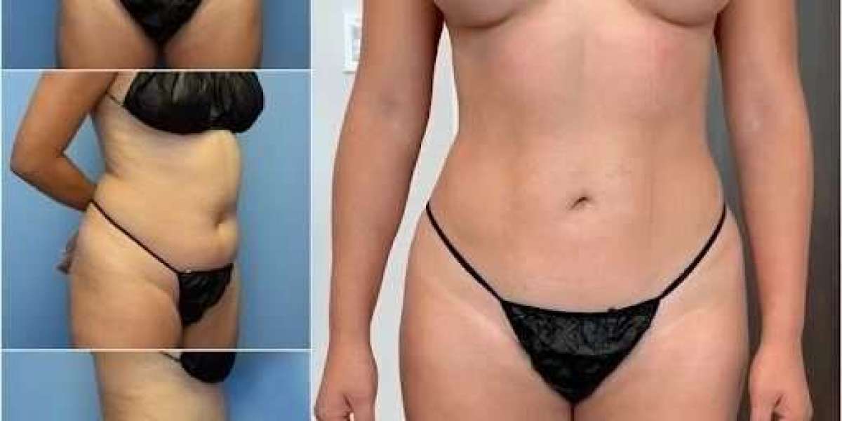 Body Contouring in Dubai: Sculpt Your Abdomen and Waist