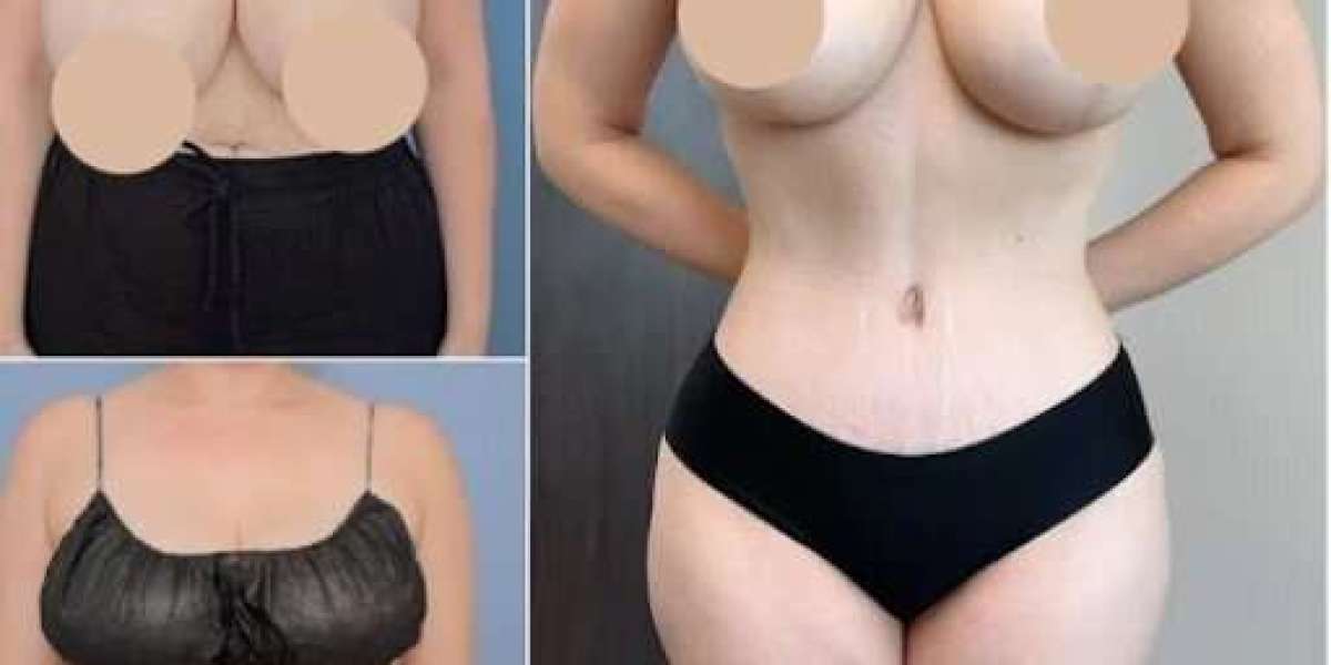 Tummy Tuck in Dubai: Costs and Pricing Guide