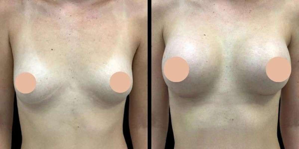 Breast Augmentation in Dubai: How Surgeons Ensure Symmetry and Natural Results