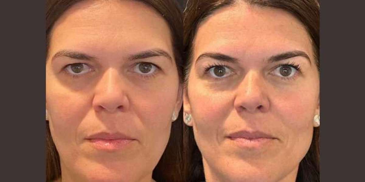 Best Plastic Surgeons in dubai: Experts in Thread Lift Treatments