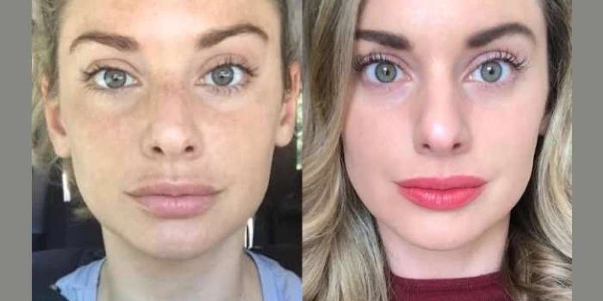 Revitalize Your Appearance with Radiofrequency Microneedling Treatments in Dubai
